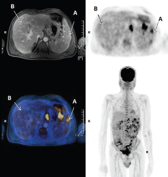 Positron-emission tomography-magnetic resonance image showing FDG avid multiple mediastinal and intra-abdominal lymph nodes, FDG avid and non-avid T2 hyperintense lesions in the spleen (arrows noted A in image) and FDG non-avid T2 hyperintense lesions in the liver (arrows noted B in image).